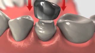 Dental Crown  Crowns And Root Canal Treatment [upl. by Eniffit]