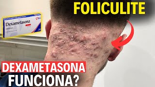 Dexametasona é eficaz para Foliculite [upl. by Rizas]