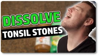 Dissolve Tonsil Stones At Home With Only 3 Ingredients [upl. by Mlehliw]