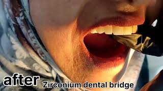 zirconia crowns dental bridge before and after [upl. by Chemush]