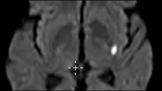 Acute lacunar infarction basal ganglia [upl. by Htiekel]