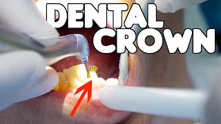 Dental Crown Procedure EXPLAINED [upl. by Eliseo232]