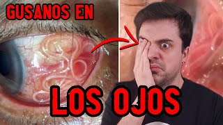 Gusanos en los ojos  LOIASIS [upl. by Airasor637]