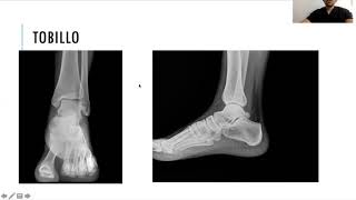 Radiología simple de miembro inferior [upl. by Notgnilra]