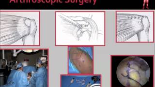 Rotator Cuff Tear Diagnosis amp Treatment [upl. by Dilisio]