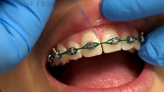 Flossing Braces With a Threader [upl. by Adla]