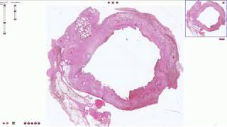 Chronic Cholecystitis  Histopathology [upl. by Ahtiekal]