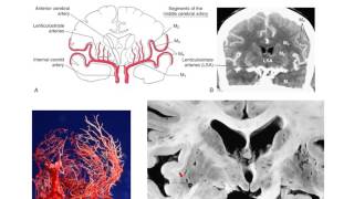 The lenticulostriate vessels and lacunar infarcts [upl. by Halimeda]