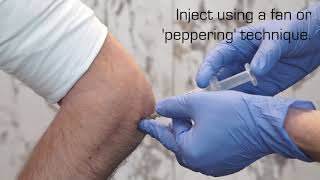 Injection Technique for Lateral Epicondylalgia [upl. by Hetti]