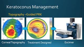 Collagen Cross Linking For keratoconus [upl. by Valle47]