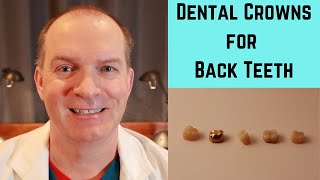 Dental Crown options for Back teeth [upl. by Alcock]