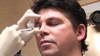 Permanent NonSurgical Rhinoplasty With Dr Robert Kotler [upl. by Nod581]