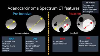 Adenocarcinoma Spectrum [upl. by Brietta503]