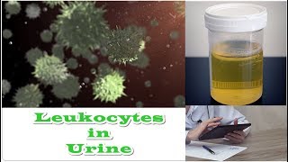 Leukocytes in Urine  No Nitrates [upl. by Poppy]