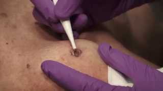 Watch amp Learn Electrosurgery [upl. by Chamkis]