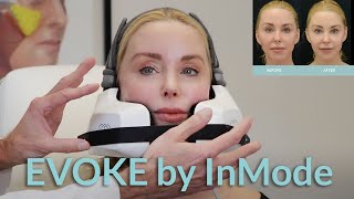 EVOKE by InMode Saggy Skin Treatment Over 50 [upl. by Nnylarej]