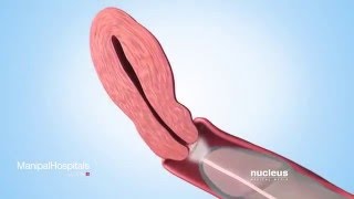 Sperm Retrieval Techniques [upl. by Yrekaz]