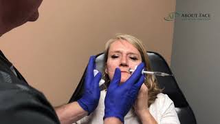 Juvederm Voluma Treatment Video [upl. by Julietta]