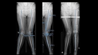 Bunions  Hallux Valgus Diagnosis Exercises Treatment [upl. by Kalvin968]