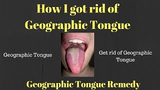 Bacterial Coating on Tongue Why it’s Bad How to Get Rid of It [upl. by Agueda]