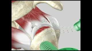 Arthroscopic Rotator Cuff Repair [upl. by Files831]