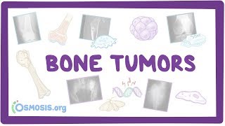 Bone tumors  causes symptoms diagnosis treatment pathology [upl. by Fanchan]