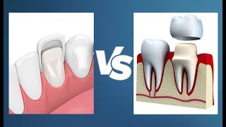 Veneers vs Crowns  Whats the Difference [upl. by Suirradal965]