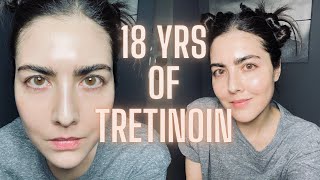 Not Seeing Results with RetinA TRETINOIN Watch This Before You Quit amp Avoid My Biggest Mistake [upl. by Dewar]