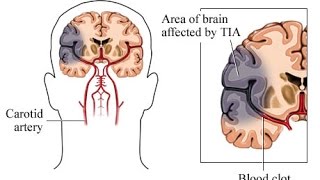 Transient Ischemic Attack TIA [upl. by Schubert]