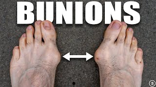 Bunions  Hallux Valgus Diagnosis Exercises Treatment [upl. by Akiaki]