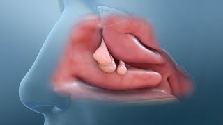 SINUSITIS CRÓNICA  POLIPOSIS NASAL BILATERAL [upl. by Fanestil]