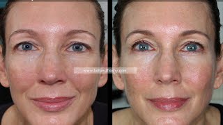 RetinA for AntiAging  3Year Results  Before amp After [upl. by Suirtimed]