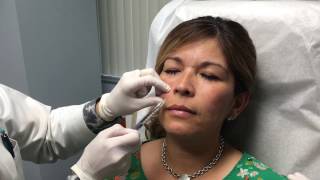 Juvederm Vollure Injection Treatment [upl. by Caterina178]