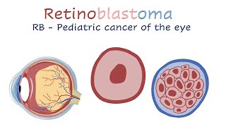 Retinoblastoma [upl. by Iat22]