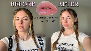 GETTING 05 SYRINGE OF JUVEDERM ULTRA PLUS XC before during amp after [upl. by Descombes]