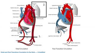 PDA Tylenol vs Indocin [upl. by Astrid]