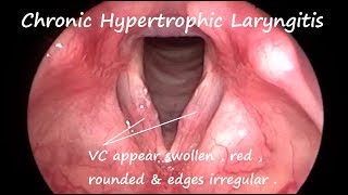 Laryngology  Chronic Hypertrophic Laryngitis [upl. by Walburga426]