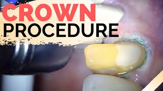 Dental Crown Explained  Anterior Crown Preparation [upl. by Mischa]