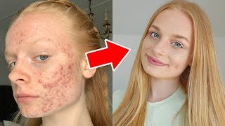 HOW I COVER MY ACNE grwm  tutorial [upl. by Ecinnahs55]