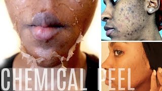 EASY CHEMICAL PEEL THAT YOU CAN DO AT HOME  INTRICATE SKIN CARE WITH AHA LACTIC ACID PEEL [upl. by Noied]