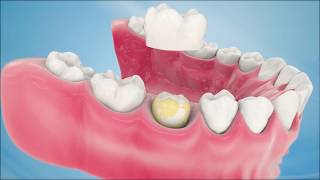 Dental Crown Procedure [upl. by Freiman334]