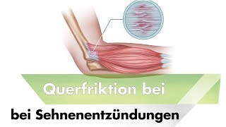 Was hilft bei Sehnentzündungen  Querfriktion [upl. by Aenat363]