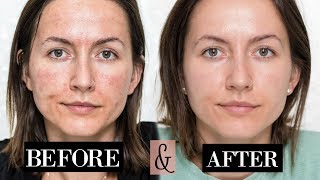 My MICRONEEDLING Experience  Skin Updates  Before amp After [upl. by Eenal936]