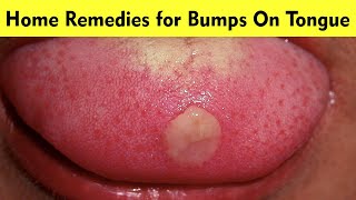 How to Get Rid of Blisters on the Tongue  Home Remedies for Mouth Ulcers [upl. by Steddman641]