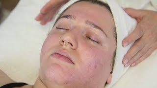 Facial Scarring Refinements The Lactic Peel [upl. by Laband]