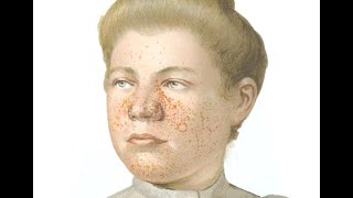 Tuberous Sclerosis [upl. by Inman]