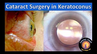 Cataract Surgery in Keratoconus [upl. by Ueik791]