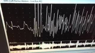 neuromyotonic discharges [upl. by O'Driscoll752]