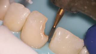 Teeth Bonding  Front tooth filling EXPLAINED [upl. by Ungley]