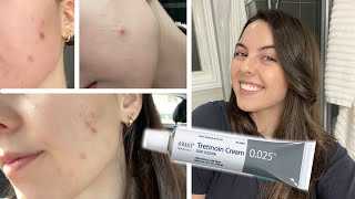 HOW I CLEARED MY SKIN IN 1 MONTH  Tretinoin Cream 0025 Before and After [upl. by Dwan]